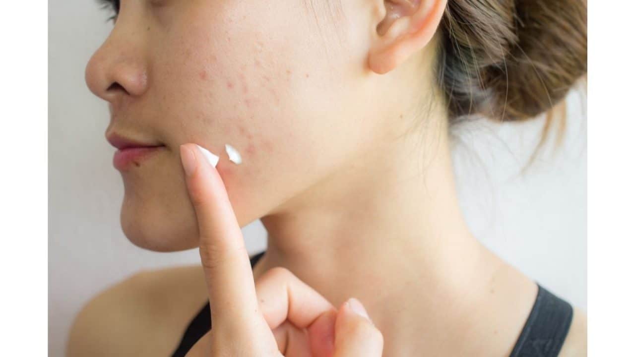 12 Rekomendasi Produk Skincare untuk Jerawat yang Ampuh